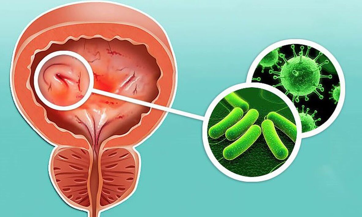 Comment se développe une infection de la vessie